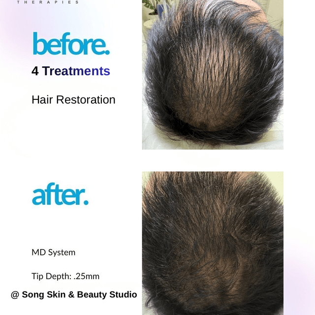 Micro Channeling hair at SONG SKIN  & BEAUTY STUDIO in Mentor, OH